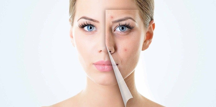 سؤالات رایج در مورد میکرونیدلینگ