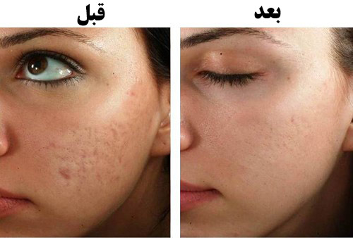 مشاهده نتایج حاصل از میکرونیدلینگ به چقدر زمان نیاز دارد؟