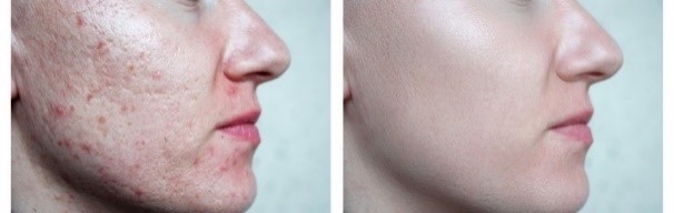 نحوه عملکرد میکرونیدلینگ جهت درمان جای جوش