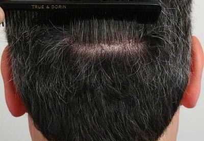 آیا در روش FUT جای زخم بر روی سر باقی میماند؟