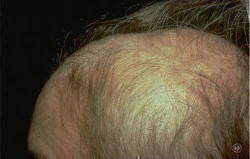 چه کسانی به ریزش موی سکه‌ای مبتلا می‌شوند؟