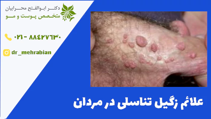علائم زگیل تناسلی در مردان 