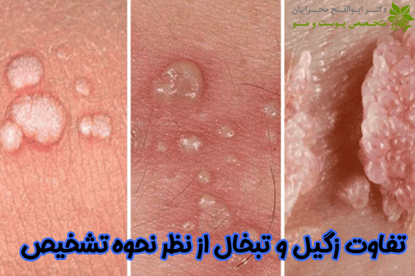 تفاوت زگیل و تبخال از نظر تشخیص
