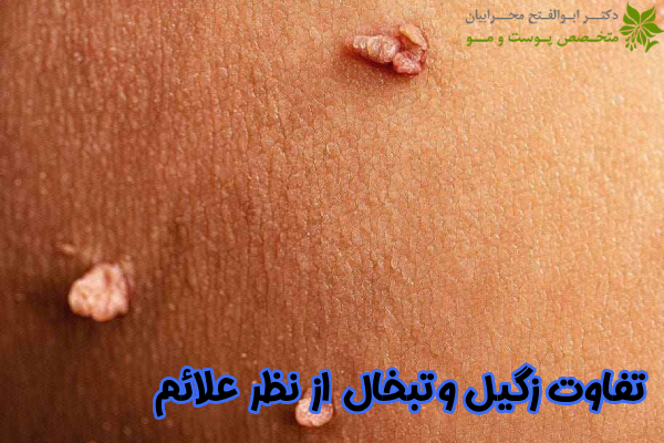 تفاوت زگیل و تبخال از نظر علائم