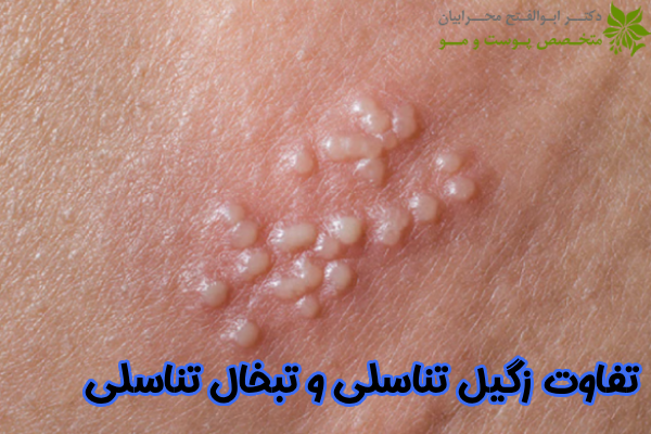 تفاوت زگیل و تبخال تناسلی