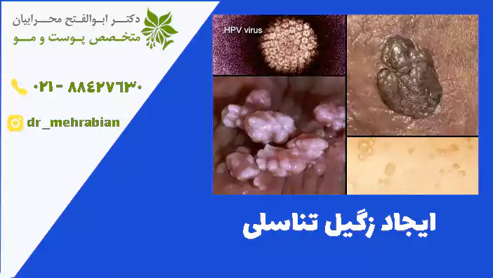 ایجاد زگیل تناسلی