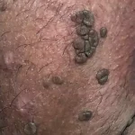 زگیل تناسلی چیست