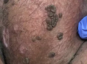 زگیل تناسلی چیست