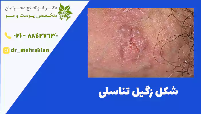شکل زگیل تناسلی