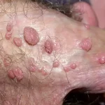 علائم زگیل تناسلی