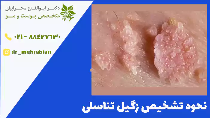 نحوه تشخیص زگیل تناسلی را بیان کنید