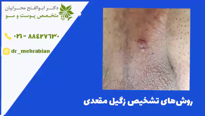 روش‌های تشخیص زگیل مقعدی
