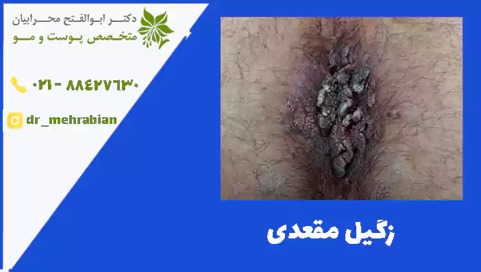 زگیل مقعدی