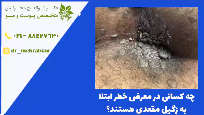 چه کسانی در معرض خطر ابتلا به زگیل مقعدی هستند؟