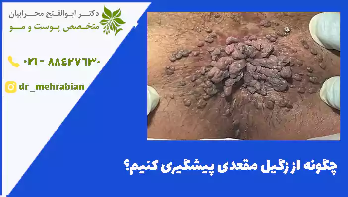 چگونه از زگیل مقعدی پیشگیری کنیم؟