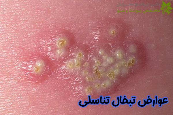 عوارض تبخال تناسلی