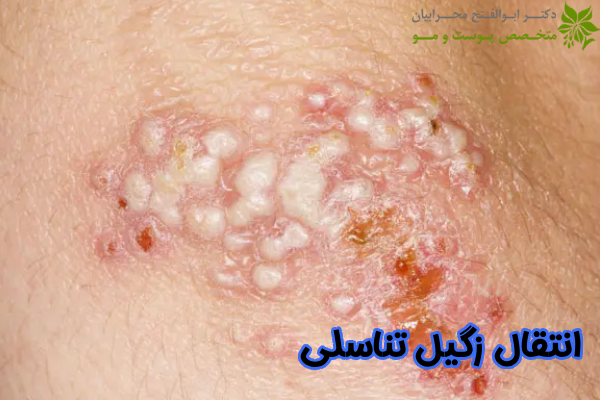 انتقال ویروس HPV
