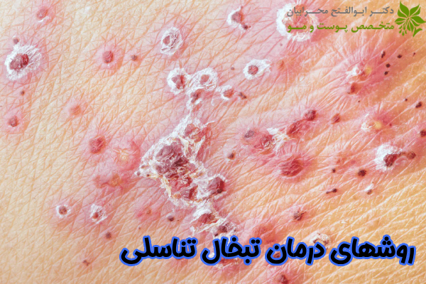 روشهای درمان تبخال تناسلی