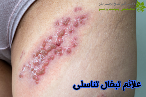 علائم تبخال تناسلی