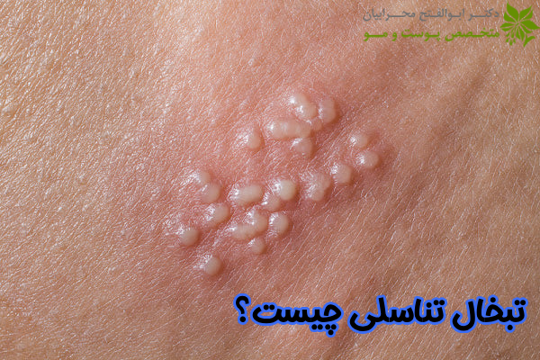 تبخال تناسلی چیست