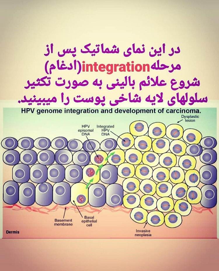 آیا زگیلهای تناسلی سرطانی می شوند؟