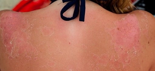 آفتاب سوختگی از عوارض برنزه کردن پوست