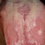 التهاب زبان یا گلوسیت نشانه چیست و چگونه درمان میشود؟