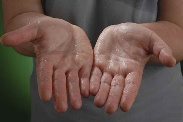 درمان تعریق کف دست با بوتاکس برای چه کسانی مناسب نیست؟