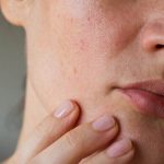 روش های بستن منافذ باز پوست میکرونیدلینگ، لیزر و پیلینگ پوست