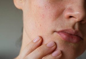 روش های بستن منافذ باز پوست میکرونیدلینگ، لیزر و پیلینگ پوست