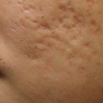 سابسیژن در درمان آکنه چه تاثیری دارد و چگونه انجام میشود؟