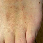 علائم و نشانه های پوستی کرونا