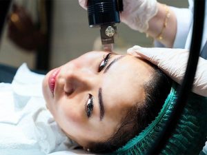 مراقبت های پس از میکرونیدلینگ نکات مهم بعد میکرونیدلینگ پوست