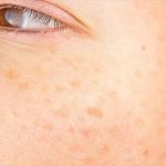 پیری زودرس ناشی از تابش آفتاب