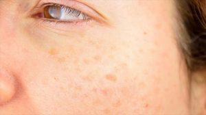 پیری زودرس ناشی از تابش آفتاب